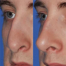 Real patient before and after photo showing nasal reconstruction surgery Seattle