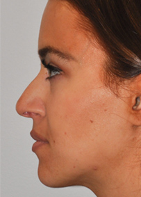 Rhinoplasty