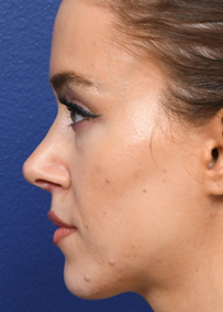 Rhinoplasty