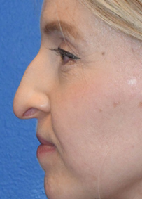 Rhinoplasty