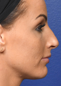 Rhinoplasty