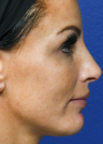 Rhinoplasty