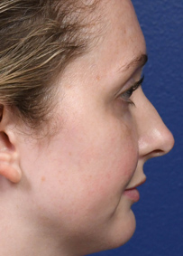 Rhinoplasty