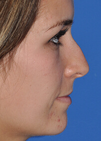 Rhinoplasty