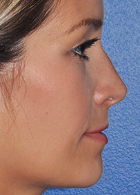 Rhinoplasty