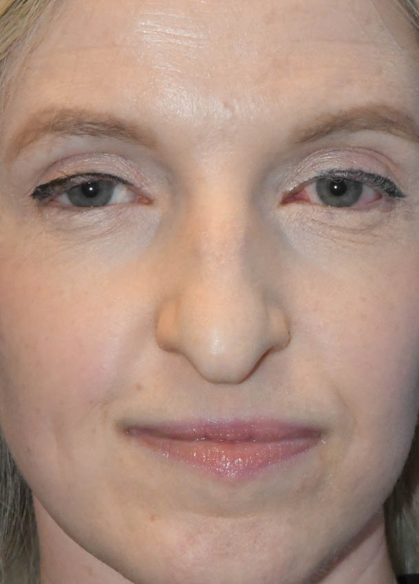 Rhinoplasty