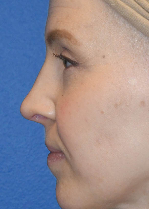 Rhinoplasty