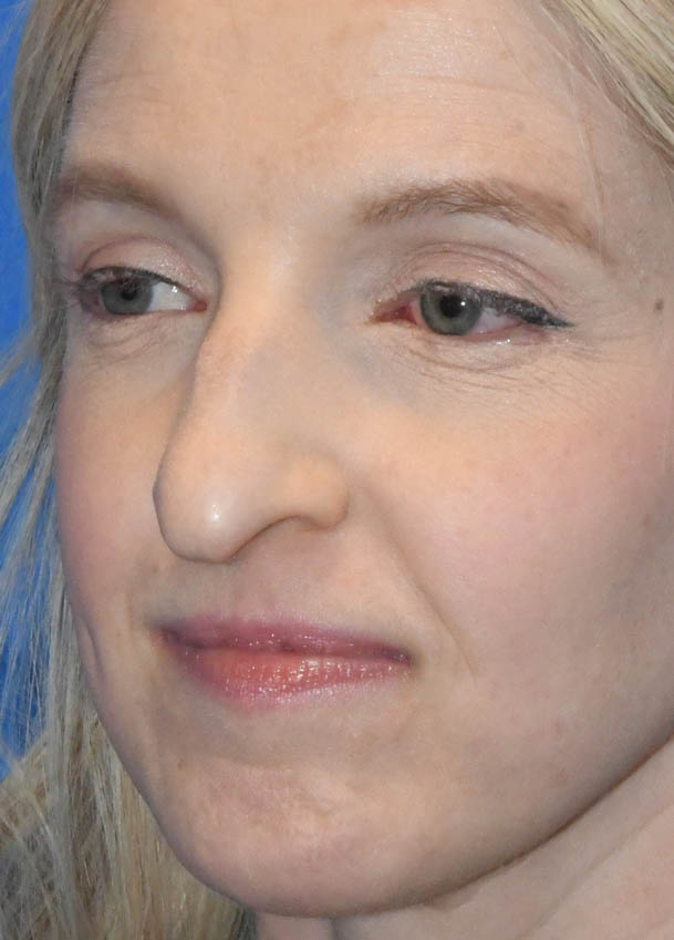 Rhinoplasty