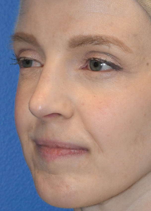 Rhinoplasty