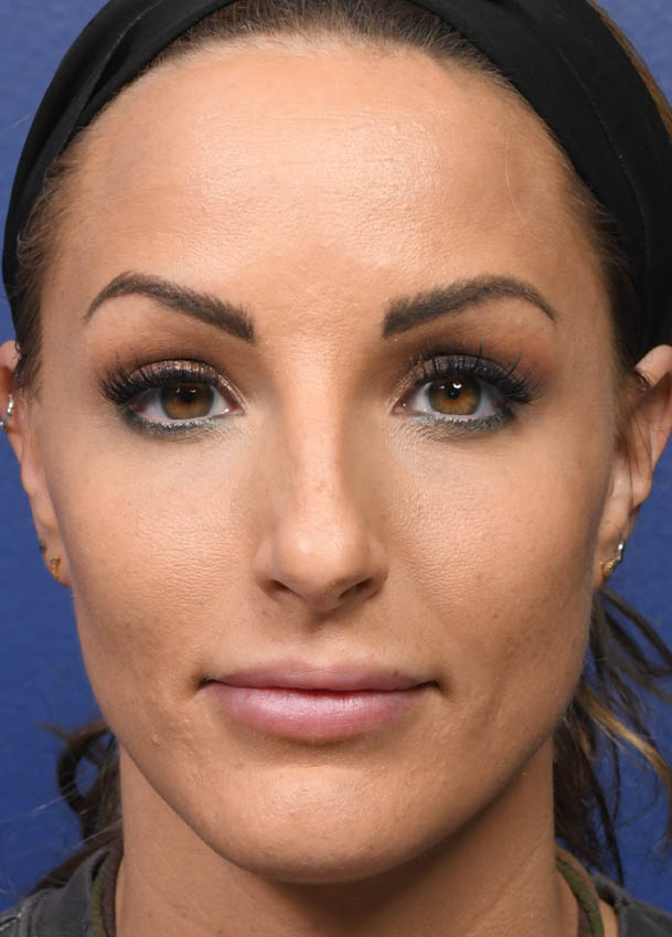 Rhinoplasty