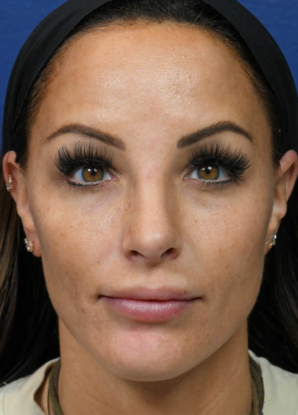 Rhinoplasty