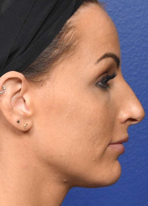 Rhinoplasty