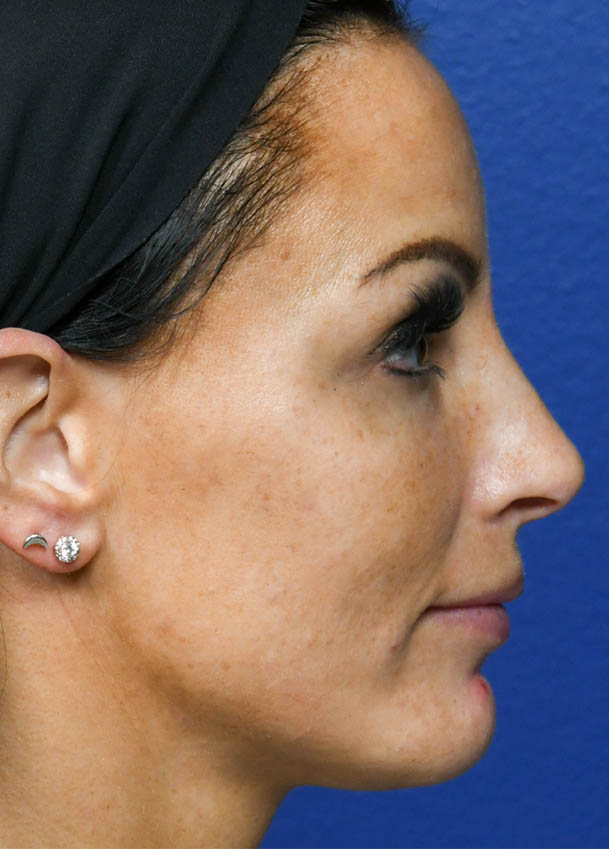 Rhinoplasty