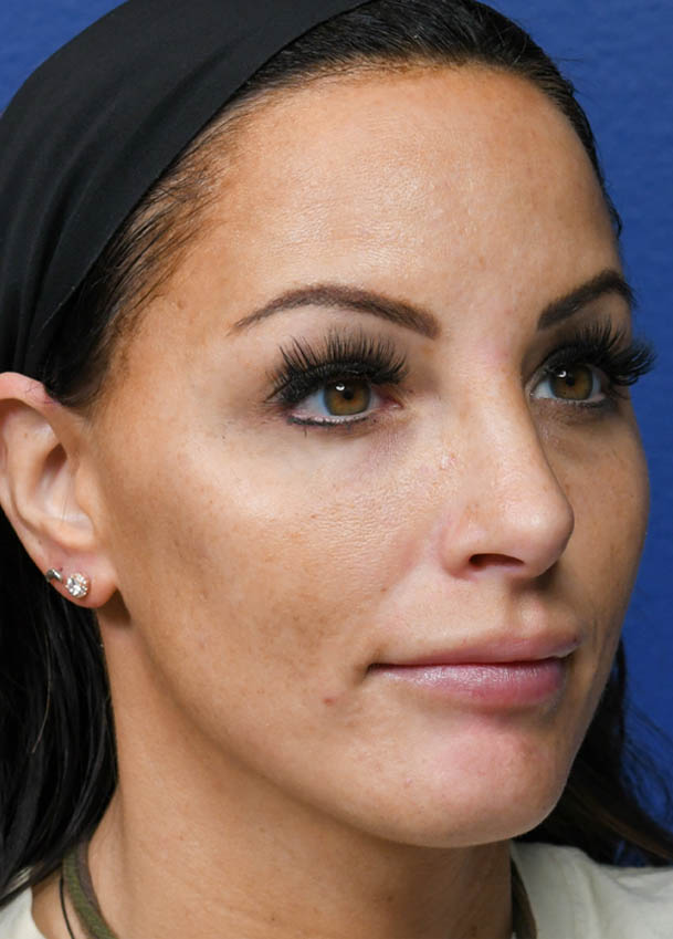 Rhinoplasty