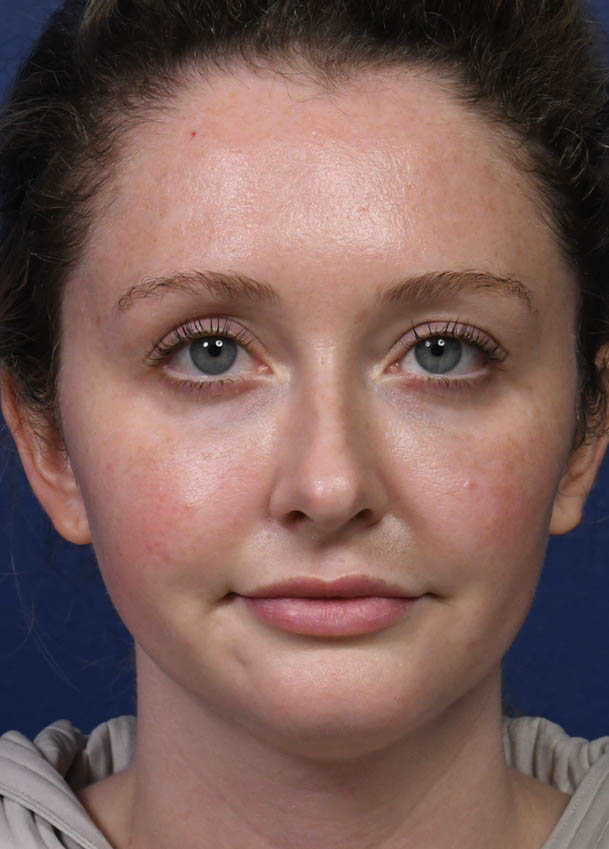 Rhinoplasty