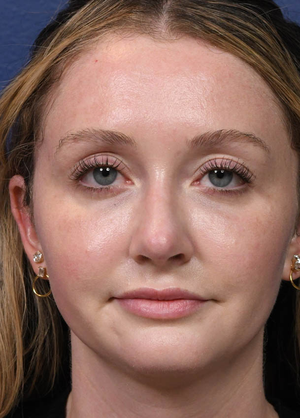 Rhinoplasty