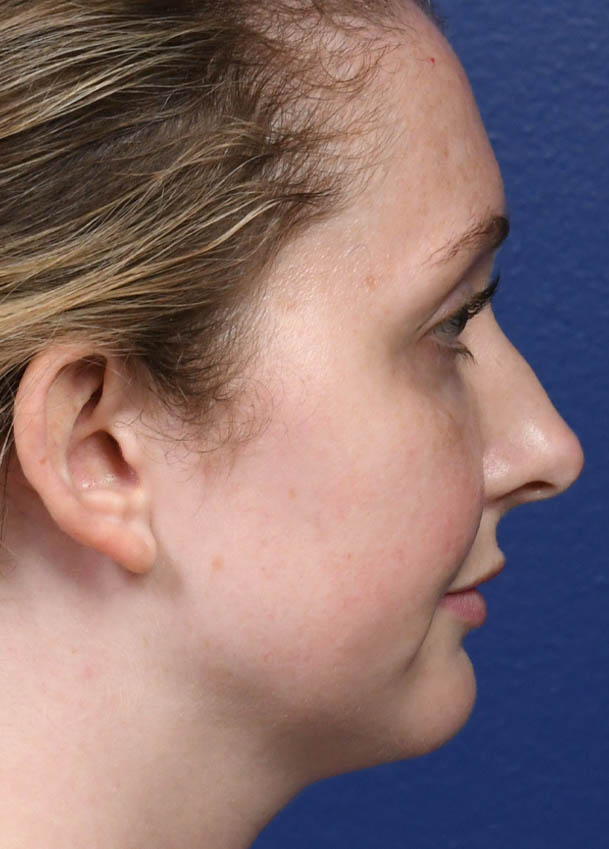 Rhinoplasty