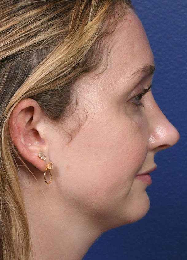 Rhinoplasty