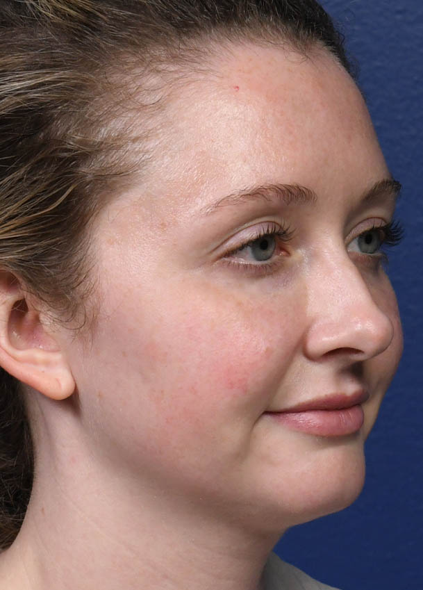 Rhinoplasty