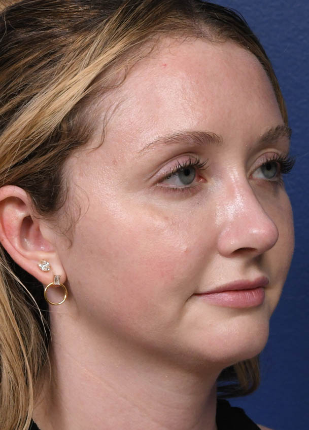 Rhinoplasty