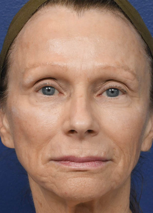 Face & Neck Lift