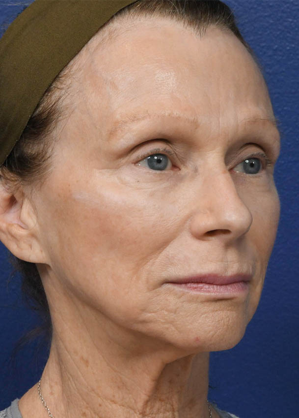 Face & Neck Lift