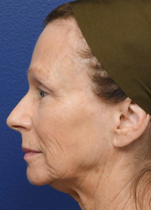 Face & Neck Lift