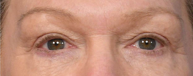 Blepharoplasty (Eyelid Lift)
