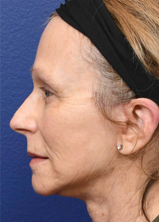 Face & Neck Lift