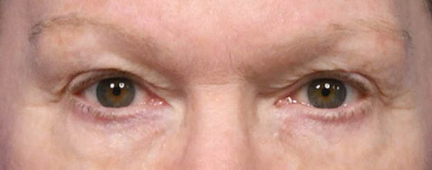 Blepharoplasty (Eyelid Lift)