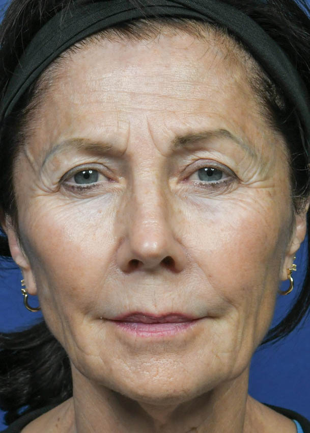 Face & Neck Lift