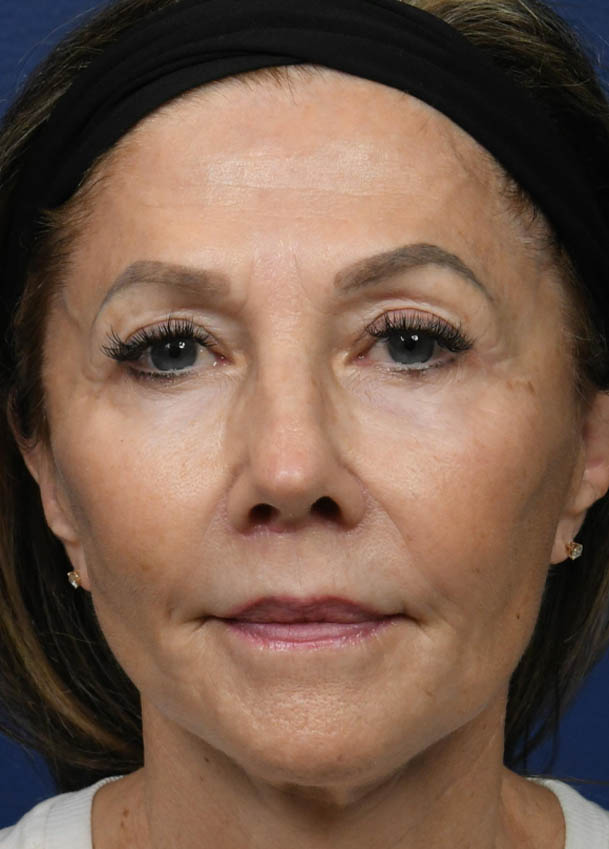 Face & Neck Lift