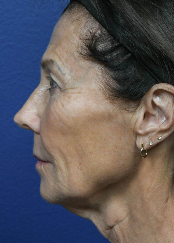 Face & Neck Lift