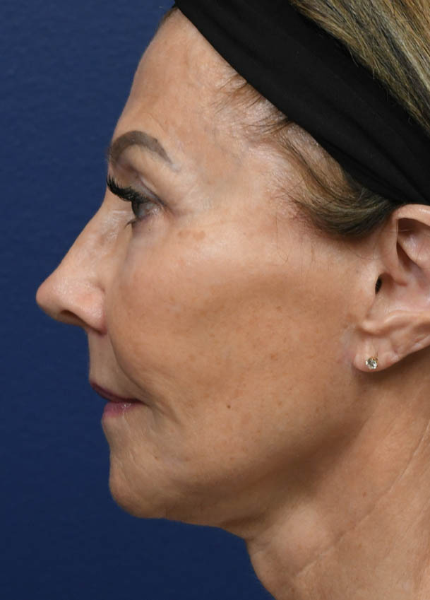 Face & Neck Lift