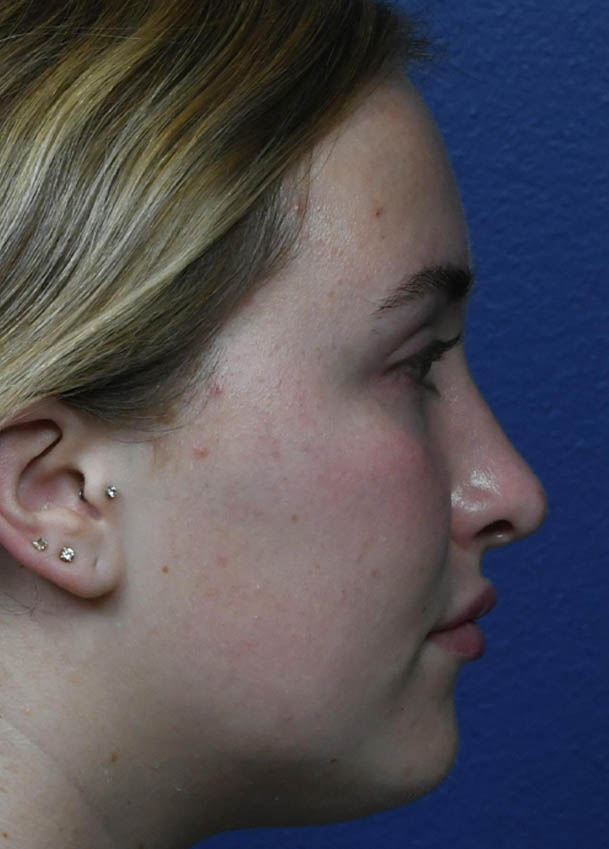 Rhinoplasty