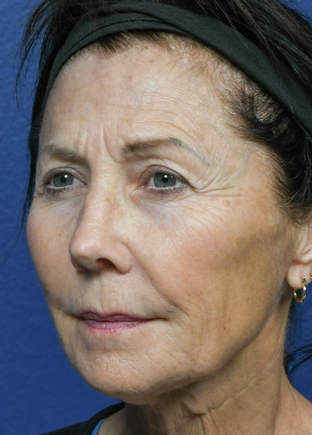 Face & Neck Lift