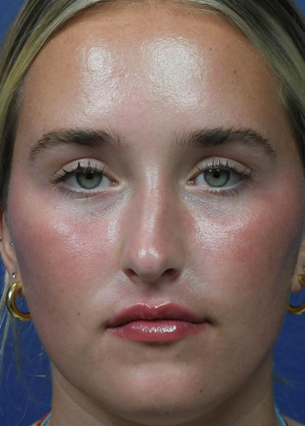 Rhinoplasty