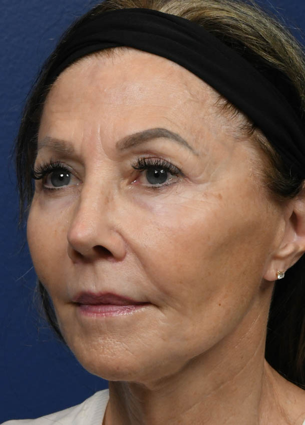 Face & Neck Lift