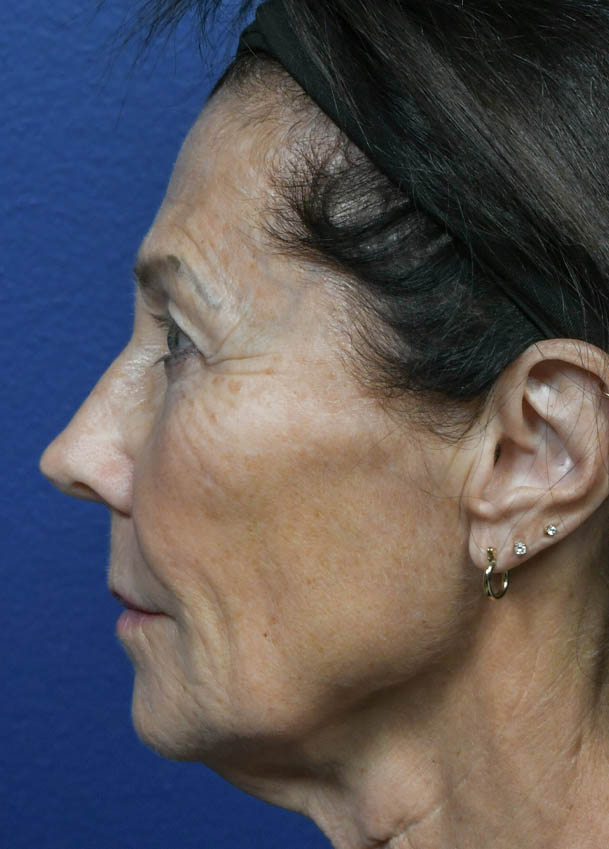 Face & Neck Lift
