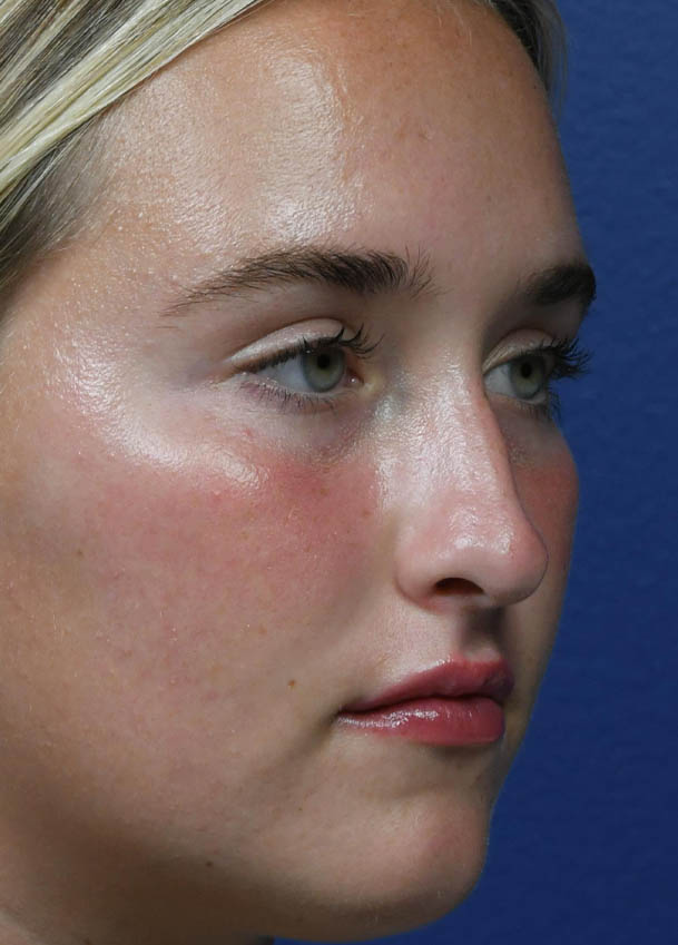 Rhinoplasty