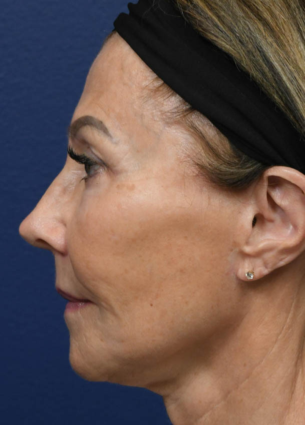 Face & Neck Lift