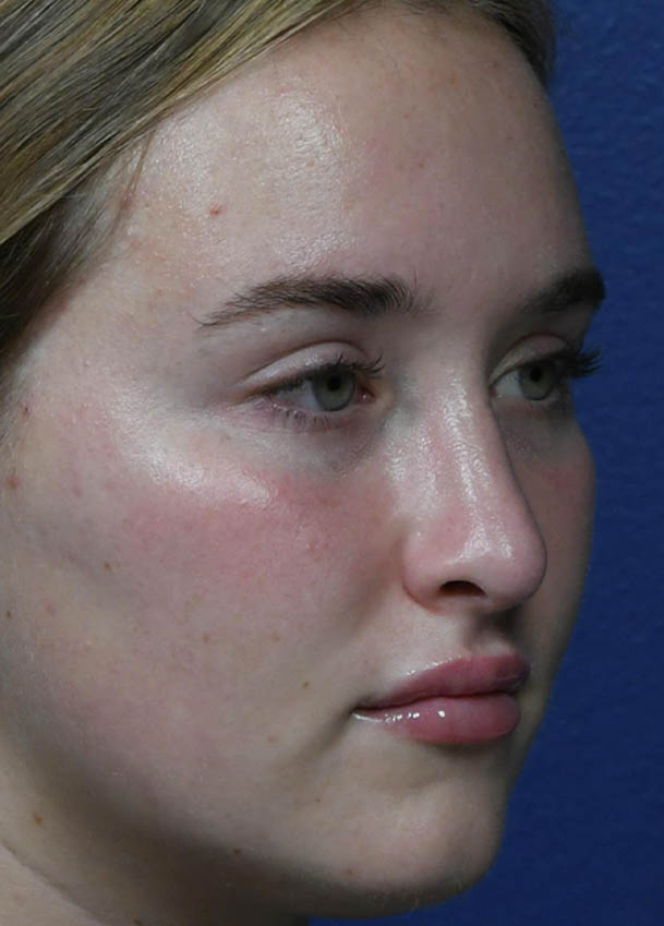 Rhinoplasty
