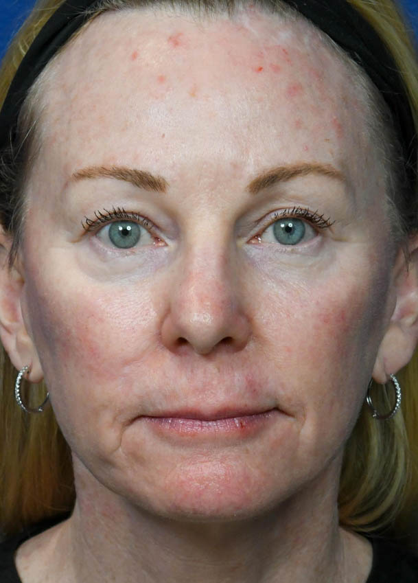 Face & Neck Lift