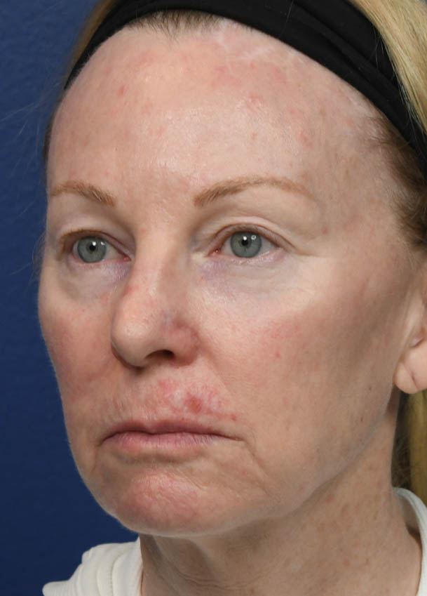 Face & Neck Lift