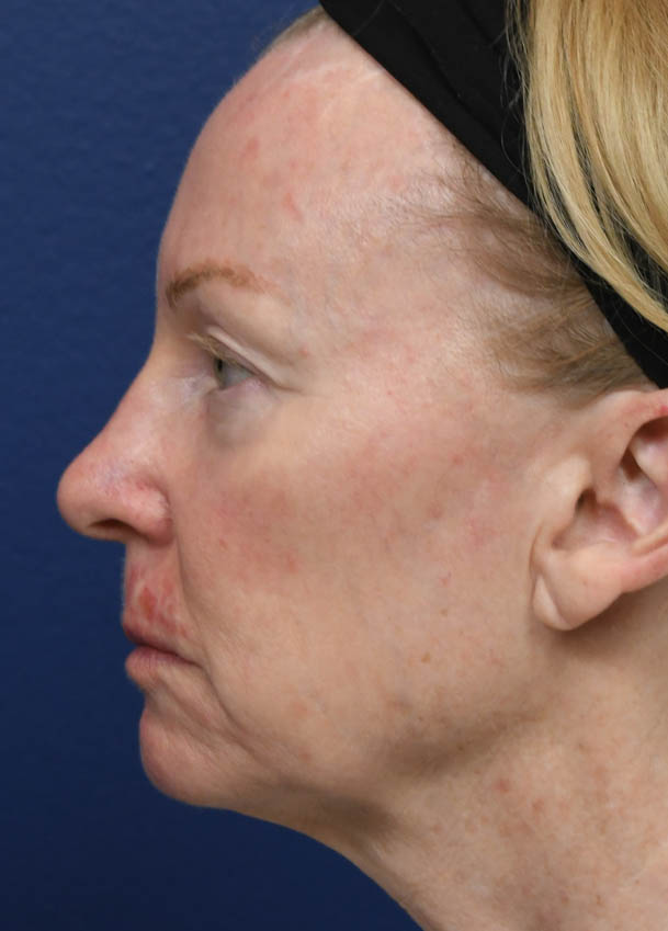 Face & Neck Lift
