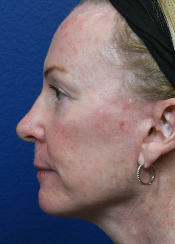 Face & Neck Lift