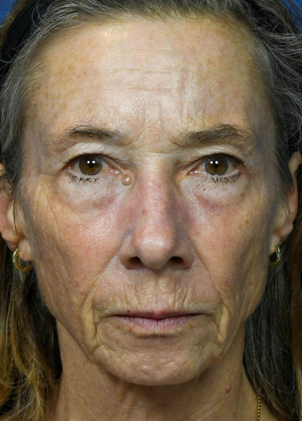 Face & Neck Lift