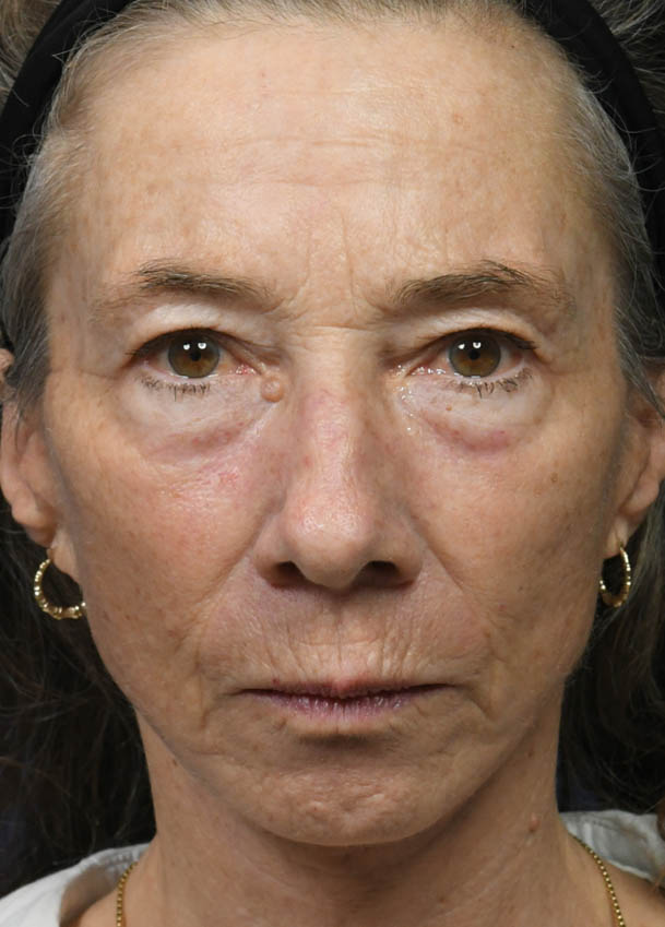 Face & Neck Lift