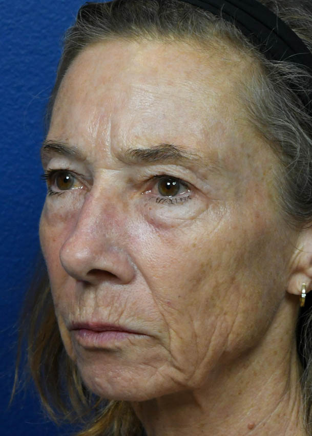 Face & Neck Lift