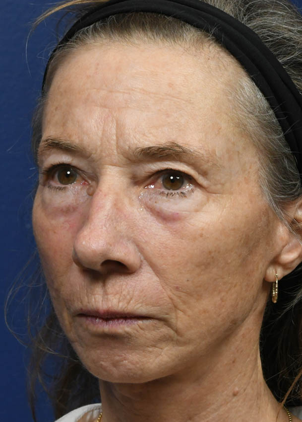 Face & Neck Lift